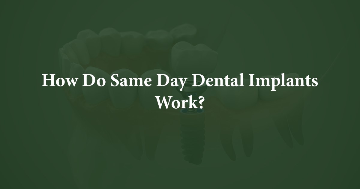How Do Same Day Dental Implants Work? at Oral and Maxillofacial Surgery Associates